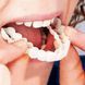 Знімні вініри для зубів Snap On Smile на 2 щелепи &bull; Накладні вініри на верхні та нижні зуби для естетичної білосніжної усмішки